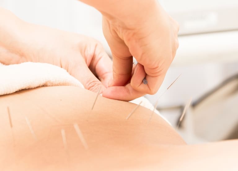 leczenie igłami akupunktura